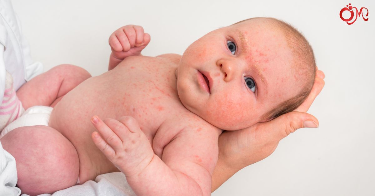 Làn da em bé rất nhạy cảm